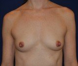 Breast Augmentation